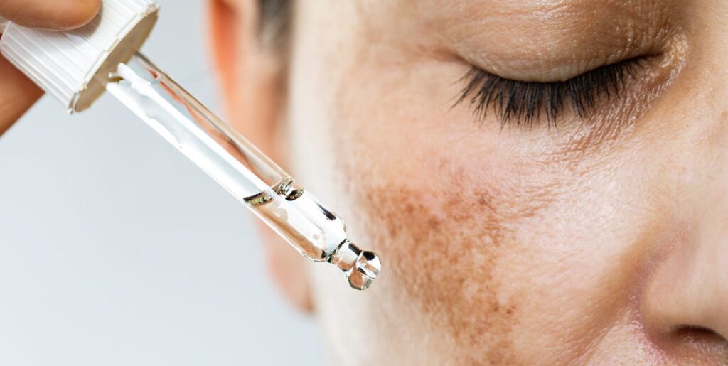 Top Dermatologist Recommended Treatments For Melasma