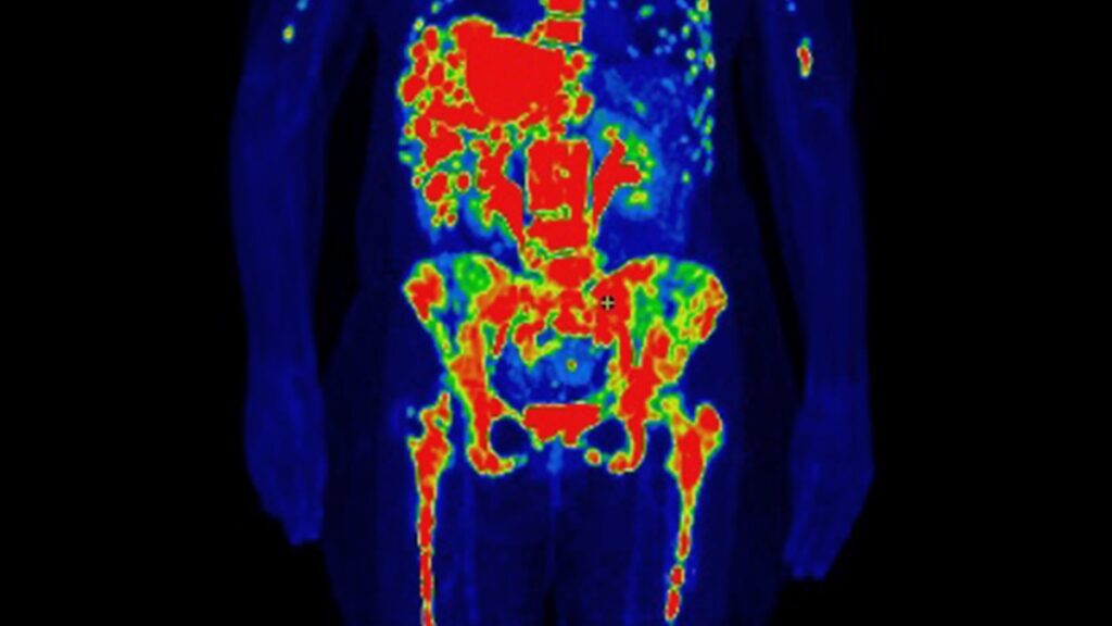 Rising cancer rates among young women: understanding the trends and