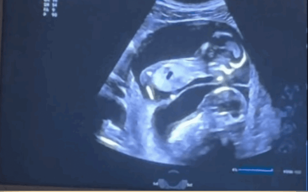 Pregnant with twins: surprising ultrasound revelations