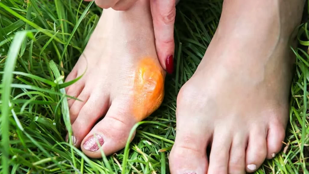 Understanding the bunion risk in women: the big toe bump